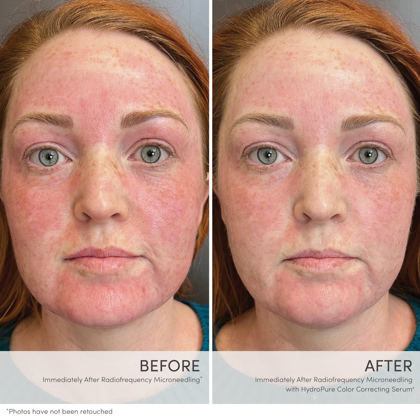 HydroPure™ Colour Correcting Serum with Hyaluronic Acid & CoQ10